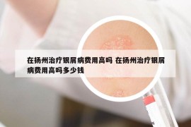 在扬州治疗银屑病费用高吗 在扬州治疗银屑病费用高吗多少钱