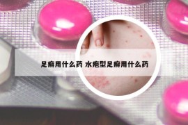 足癣用什么药 水疱型足癣用什么药