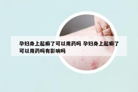 孕妇身上起癣了可以用药吗 孕妇身上起癣了可以用药吗有影响吗
