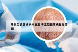 寻常型银屑病半年复发 寻常型银屑病复发周期