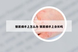银屑病手上怎么办 银屑病手上会长吗
