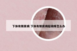 下体有银屑病 下体有银屑病超级痒怎么办
