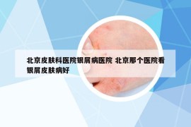 北京皮肤科医院银屑病医院 北京那个医院看银屑皮肤病好