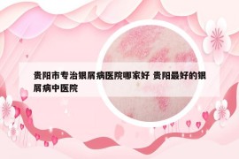 贵阳市专治银屑病医院哪家好 贵阳最好的银屑病中医院