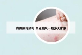 白癫疯传染吗 白点癫风一般多久扩散