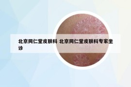 北京同仁堂皮肤科 北京同仁堂皮肤科专家坐诊