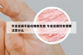 牛皮皮癣不能吃哪些东西 牛皮皮癣饮食需要注意什么