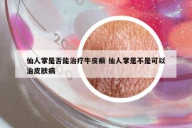 仙人掌是否能治疗牛皮癣 仙人掌是不是可以治皮肤病