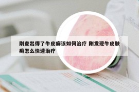 刚查出得了牛皮癣该如何治疗 刚发现牛皮肤癣怎么快速治疗