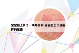 宝宝脸上长了一块牛皮癣 宝宝脸上长皮癣一样的东西