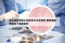 银屑病有遗传小孩有多大才会发现 银屑病遗传是生下来就有吗