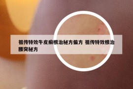 祖传特效牛皮癣根治秘方偏方 祖传特效根治腰突秘方