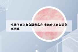 小孩子身上有白斑怎么办 小孩身上有白斑怎么回事