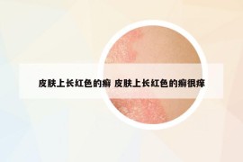 皮肤上长红色的癣 皮肤上长红色的癣很痒