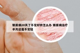 银屑病20天了不见好转怎么办 银屑病治疗半月还是不见轻