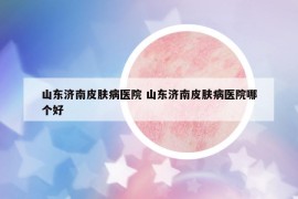 山东济南皮肤病医院 山东济南皮肤病医院哪个好