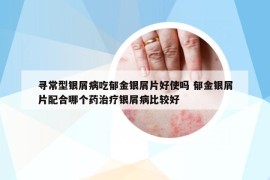 寻常型银屑病吃郁金银屑片好使吗 郁金银屑片配合哪个药治疗银屑病比较好