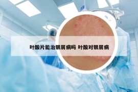 叶酸片能治银屑病吗 叶酸对银屑病
