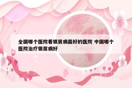 全国哪个医院看银屑病最好的医院 中国哪个医院治疗银屑病好
