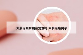 大蓟治银屑病会复发吗 大蓟治癌例子