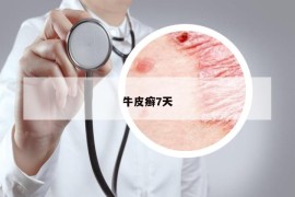 牛皮癣7天