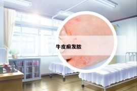 牛皮癣发脓