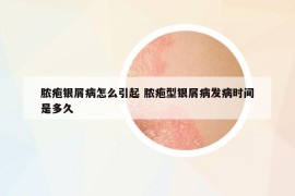脓疱银屑病怎么引起 脓疱型银屑病发病时间是多久