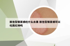 脓包型银屑病吃什么水果 脓包型银屑病可以吃西红柿吗