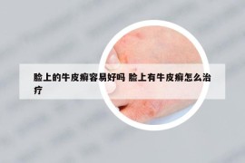 脸上的牛皮癣容易好吗 脸上有牛皮癣怎么治疗