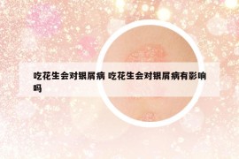 吃花生会对银屑病 吃花生会对银屑病有影响吗
