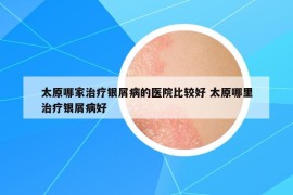 太原哪家治疗银屑病的医院比较好 太原哪里治疗银屑病好