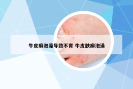 牛皮癣泡澡导致不育 牛皮肤癣泡澡