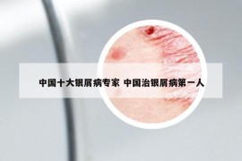 中国十大银屑病专家 中国治银屑病第一人