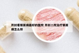 开封看银屑病最好的医院 开封二院治疗银屑病怎么样