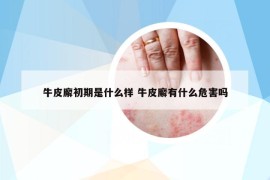 牛皮廨初期是什么样 牛皮廨有什么危害吗
