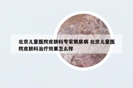 北京儿童医院皮肤科专家银屑病 北京儿童医院皮肤科治疗效果怎么样