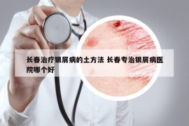 长春治疗银屑病的土方法 长春专治银屑病医院哪个好