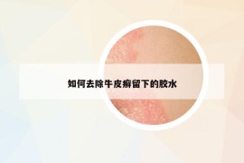 如何去除牛皮癣留下的胶水