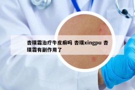 杏璞霜治疗牛皮癣吗 杏璞xingpu 杏璞霜有副作用了