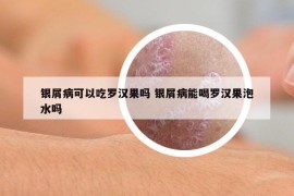 银屑病可以吃罗汉果吗 银屑病能喝罗汉果泡水吗