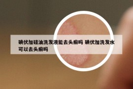 碘伏加硅油洗发液能去头癣吗 碘伏加洗发水可以去头癣吗