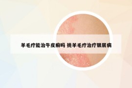 羊毛疔能治牛皮癣吗 挑羊毛疔治疗银屑病