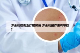洋金花胶囊治疗银屑病 洋金花副作用有哪些?