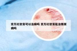 京万红软膏可以治癣吗 京万红软膏能治银屑病吗