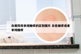 白癜风和单纯糠疹的区别图片 白色糠疹或者单纯糠疹