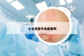 小女孩患牛皮癣案例