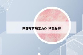 颈部痒有癣怎么办 颈部起癣