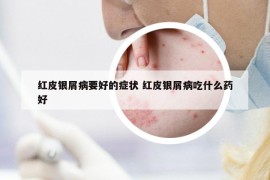 红皮银屑病要好的症状 红皮银屑病吃什么药好