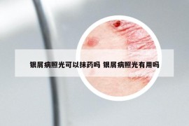 银屑病照光可以抹药吗 银屑病照光有用吗