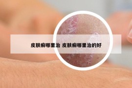 皮肤癣哪里治 皮肤癣哪里治的好